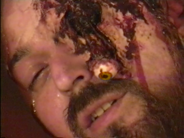 Male murder victim with disgorged eye