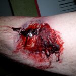 a closeup of a wound on a man's arm