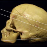 a picture of a skull diagram with multiple lines going across it.